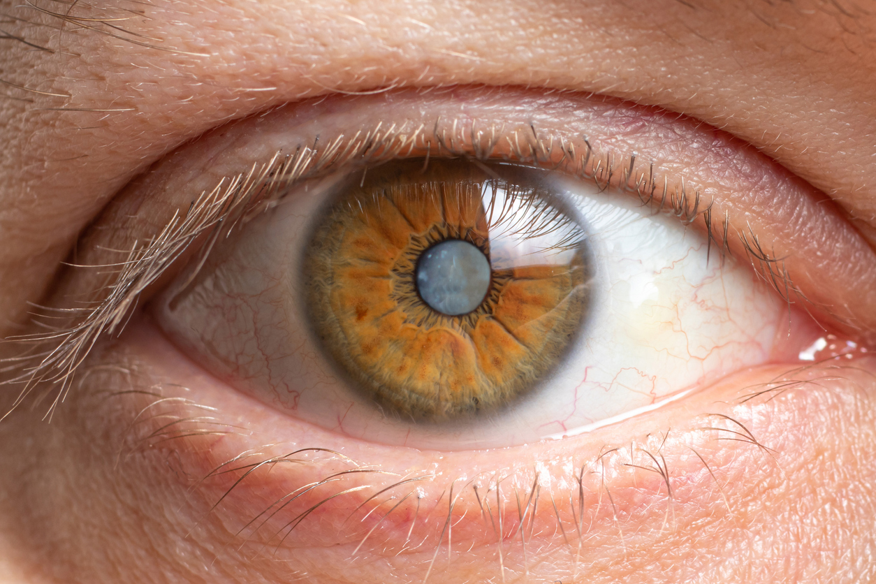 Read more about the article 7 Signs It’s Time to Transition from Glaucoma Drops to Surgery